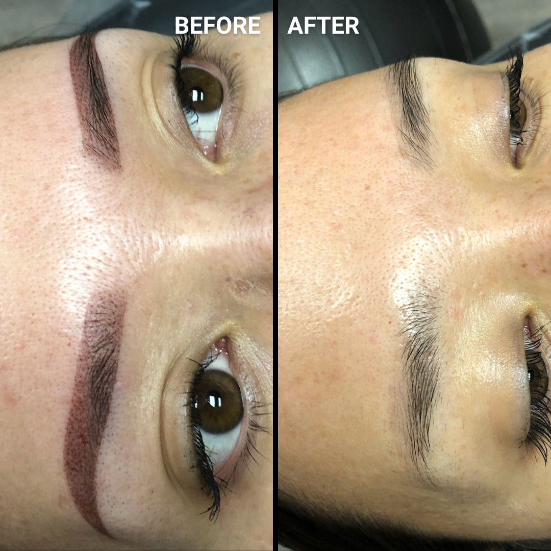 Before emergency Li-FT® saline lightening shown on left. After emergency Li-FT® saline lightening shown on right; the bad brows are completely gone! Done by artist Michon Martinez
