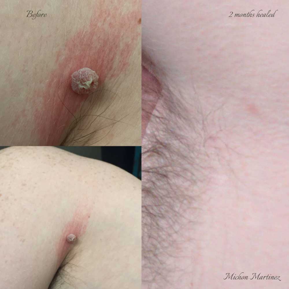 Artist Michon Martinez before and after skin tag removal next to the armpit