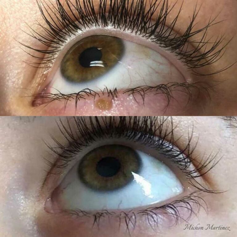 Artist Michon Martinez before and after skin tag removal below bottom eyelash line
