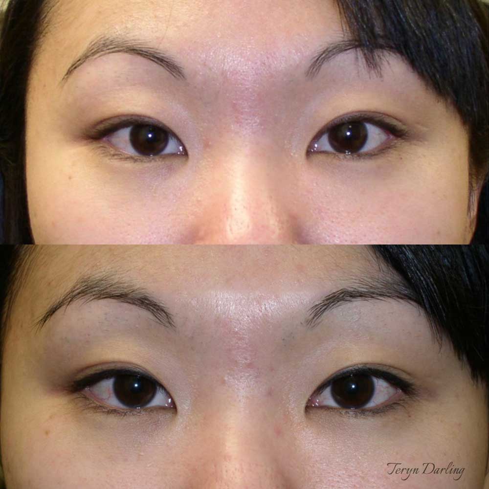 By Artist Teryn Darling: top is before procedure; bottom is after top eyeliner procedure