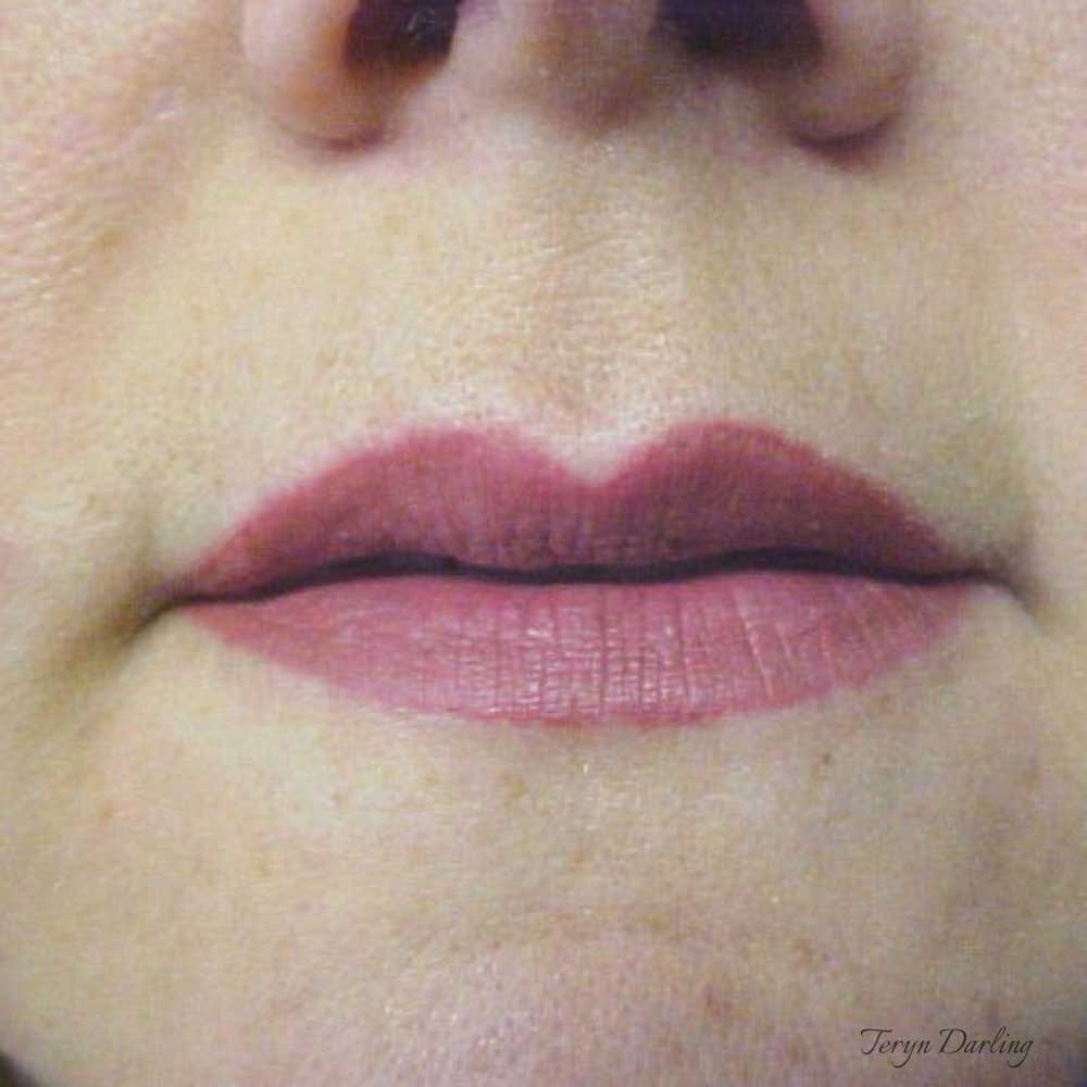 By Artist Teryn Darling: an after of lip procedure