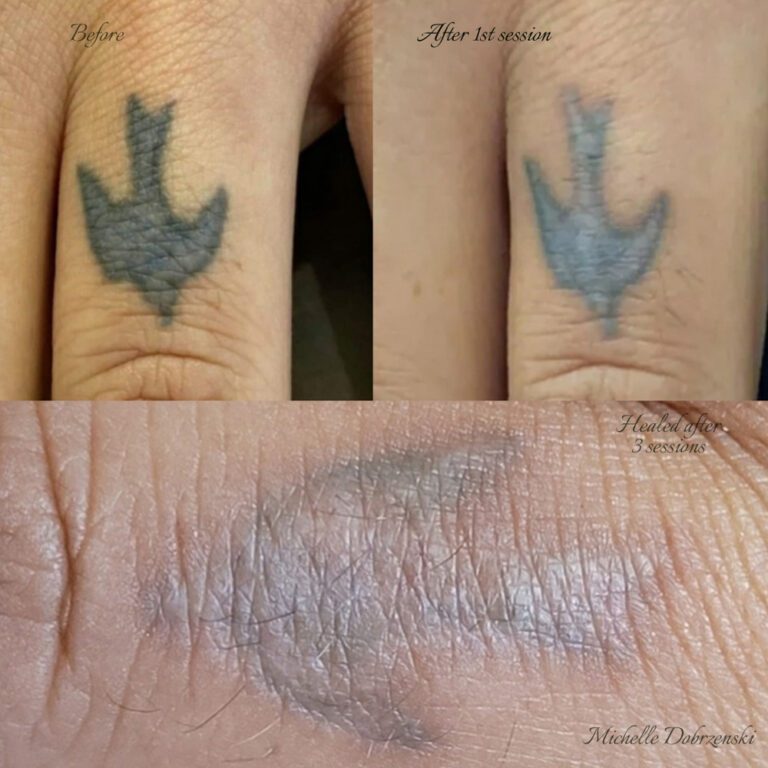 Top left shows hand tattoo of bird before Li-FT® lightening, the top right shows after 1st session removal, the bottom shows healed after 3 sessions. Done by Michelle Dobrzenski